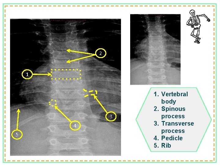 2 1 3 4 5 1. Vertebral body 2. Spinous process 3. Transverse process
