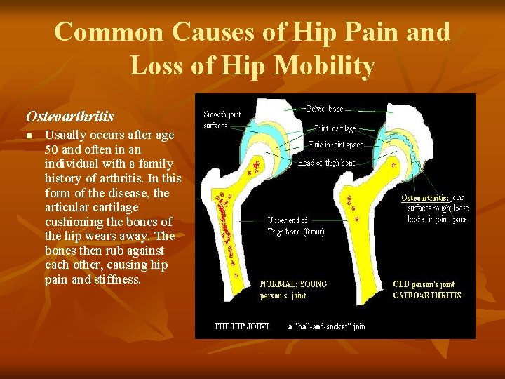 Common Causes of Hip Pain and Loss of Hip Mobility Osteoarthritis n Usually occurs