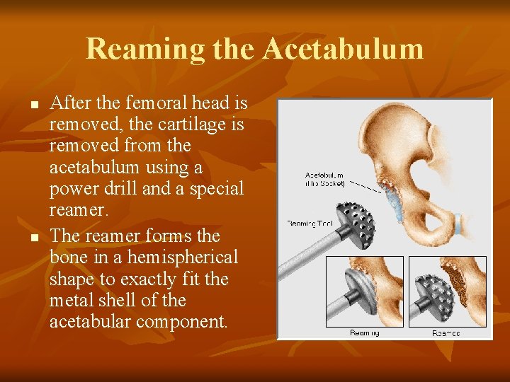 Reaming the Acetabulum n n After the femoral head is removed, the cartilage is