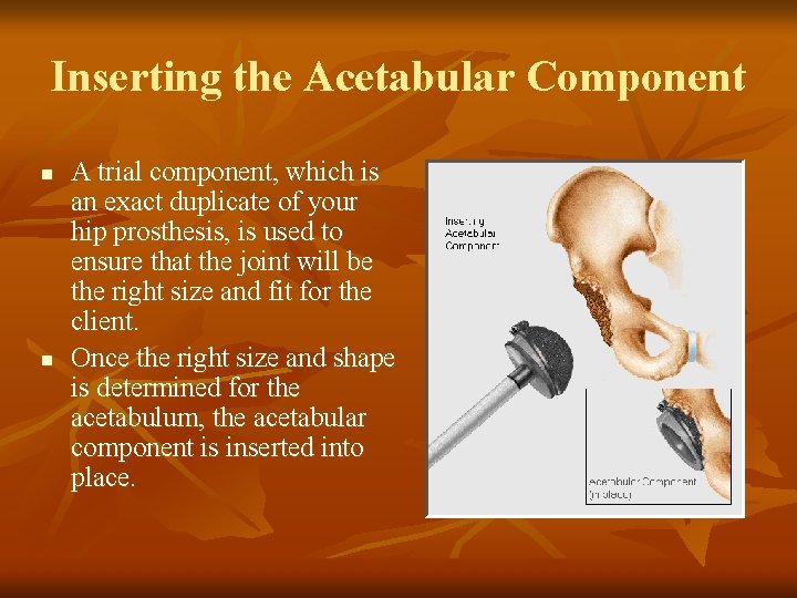 Inserting the Acetabular Component n n A trial component, which is an exact duplicate