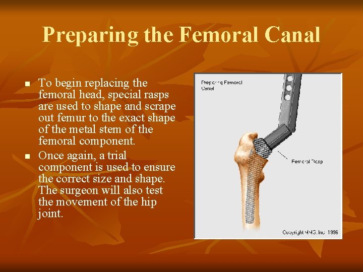 Preparing the Femoral Canal n n To begin replacing the femoral head, special rasps