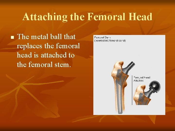Attaching the Femoral Head n The metal ball that replaces the femoral head is