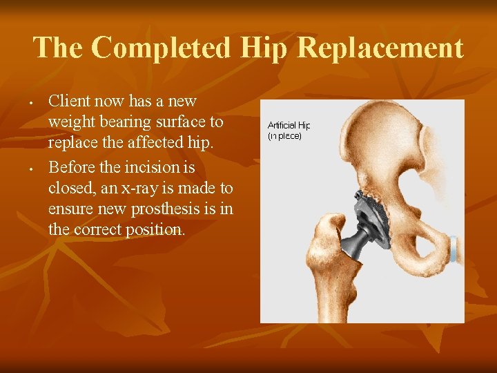 The Completed Hip Replacement • • Client now has a new weight bearing surface