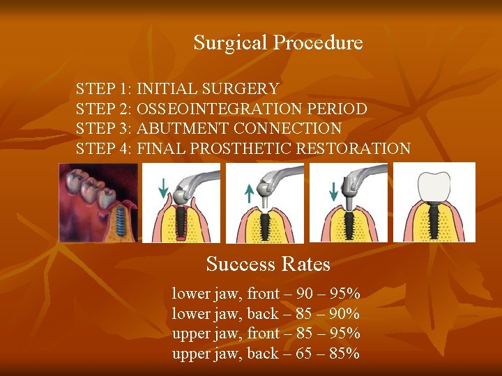 Surgical Procedure STEP 1: INITIAL SURGERY STEP 2: OSSEOINTEGRATION PERIOD STEP 3: ABUTMENT CONNECTION