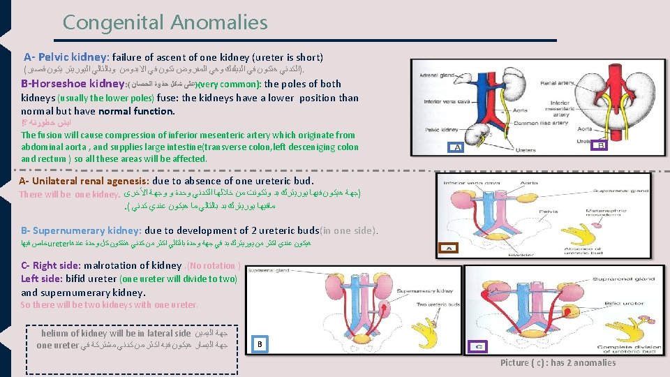 Congenital Anomalies A- Pelvic kidney: failure of ascent of one kidney (ureter is short)