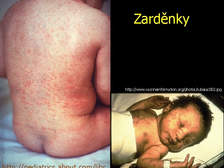 Zarděnky http: //www. vaccineinformation. org/photos/rubeiac 002. jpg 