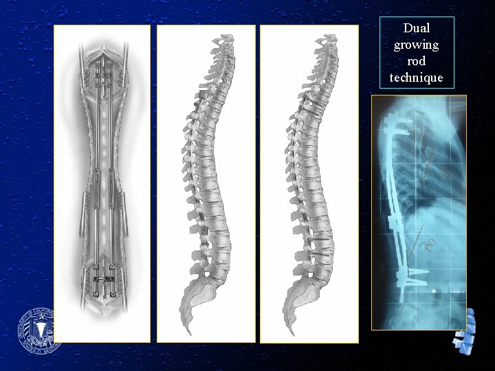 Dual growing rod technique 