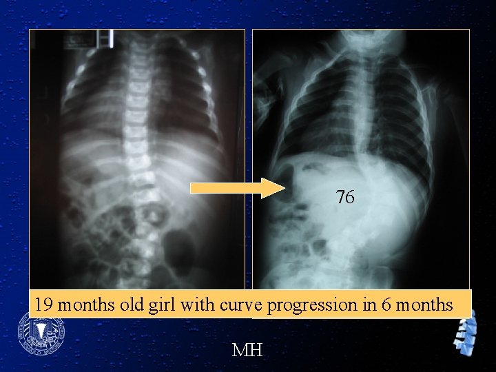 76 19 months old girl with curve progression in 6 months MH 