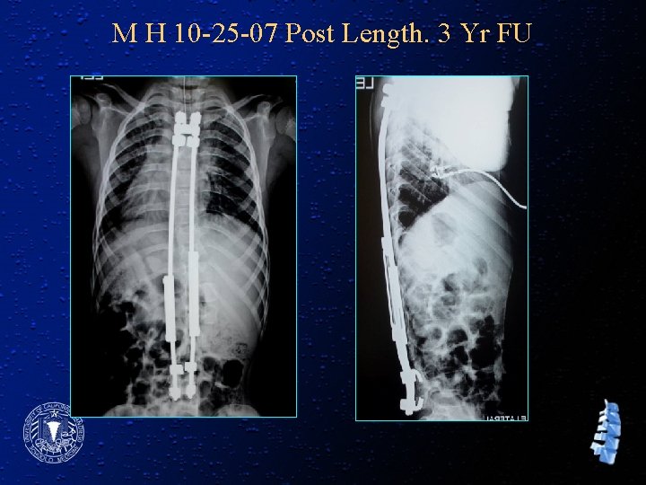 M H 10 -25 -07 Post Length. 3 Yr FU 