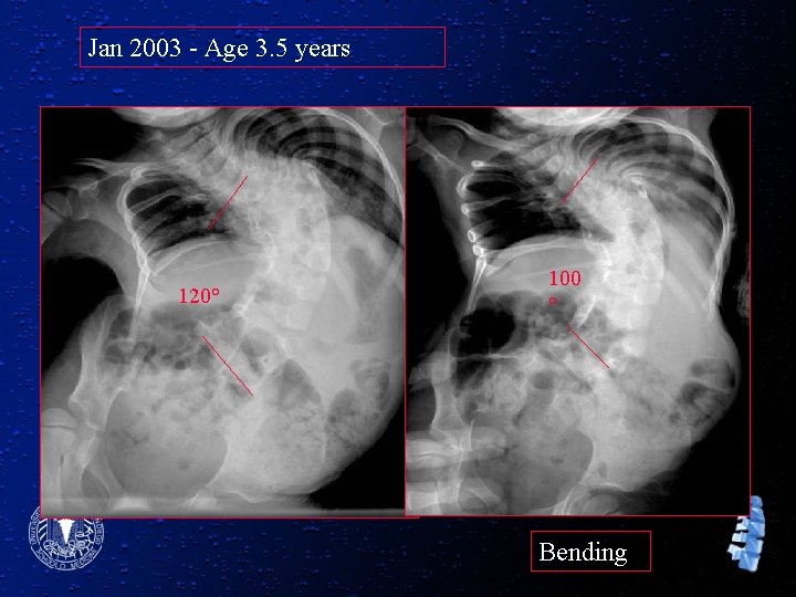 Jan 2003 - Age 3. 5 years 120° 100 ° Bending 