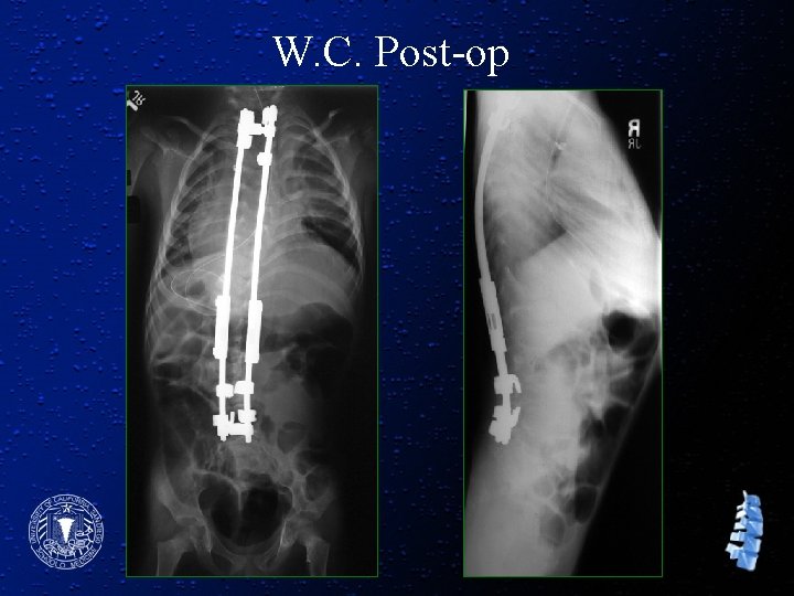 W. C. Post-op 