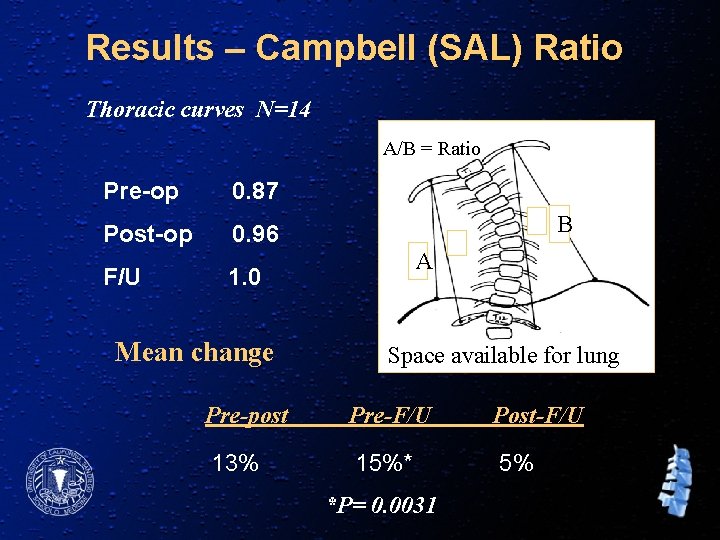 Results – Campbell (SAL) Ratio Thoracic curves N=14 A/B = Ratio Pre-op 0. 87