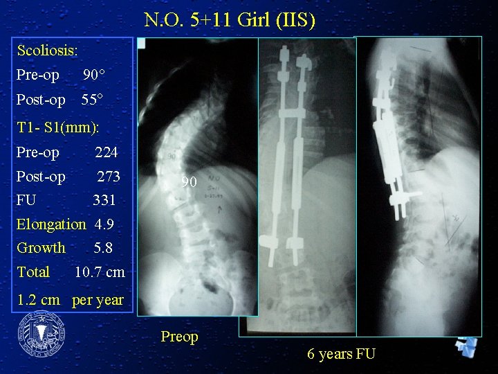 N. O. 5+11 Girl (IIS) Scoliosis: Pre-op 90° Post-op 55° T 1 - S