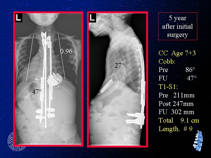 5 year after initial surgery 0. 96 27° 47° CC Age 7+3 Cobb: Pre