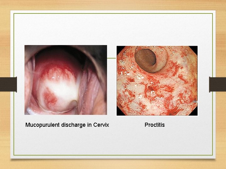  Mucopurulent discharge in Cervix Proctitis 