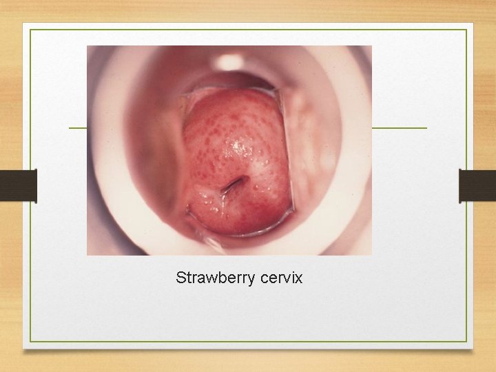  Strawberry cervix 