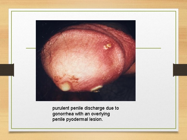 purulent penile discharge due to gonorrhea with an overlying penile pyodermal lesion. 