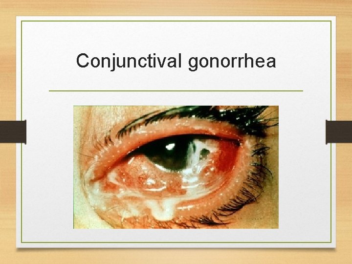 Conjunctival gonorrhea 