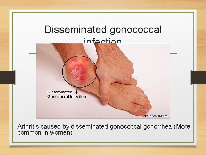 Disseminated gonococcal infection Arthritis caused by disseminated gonococcal gonorrhea (More common in women) 