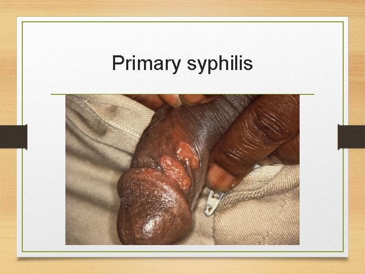 Primary syphilis 
