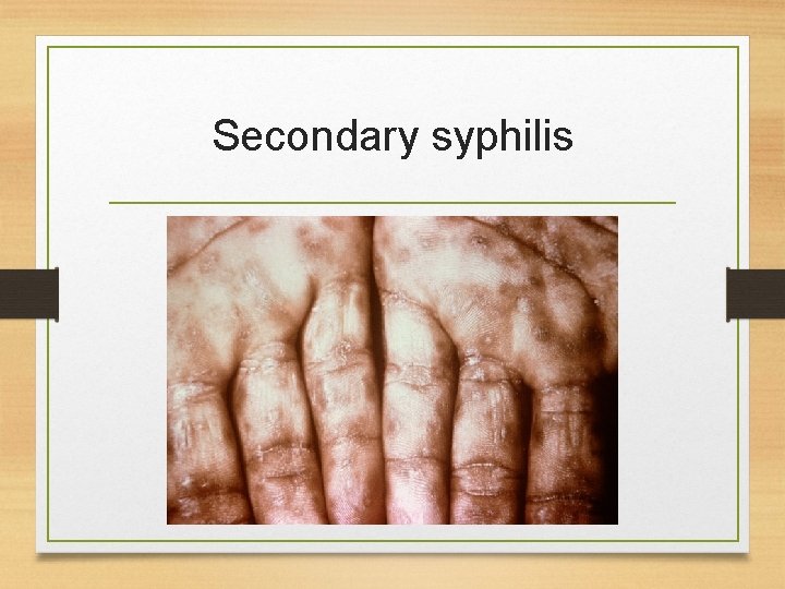 Secondary syphilis 