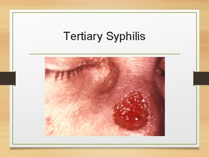 Tertiary Syphilis 