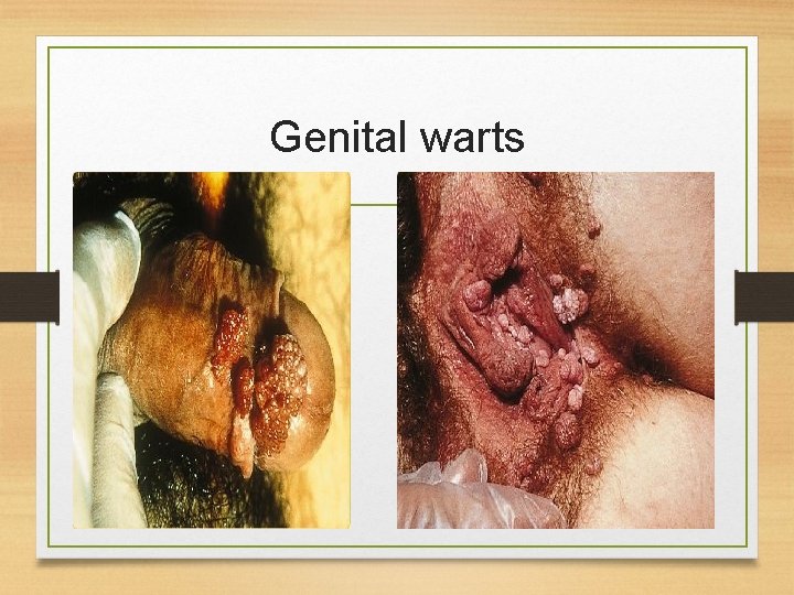 Genital warts 