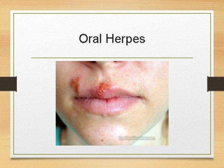 Oral Herpes 