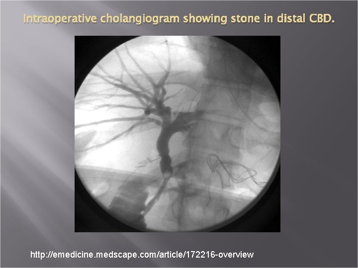 Intraoperative cholangiogram showing stone in distal CBD. http: //emedicine. medscape. com/article/172216 -overview 