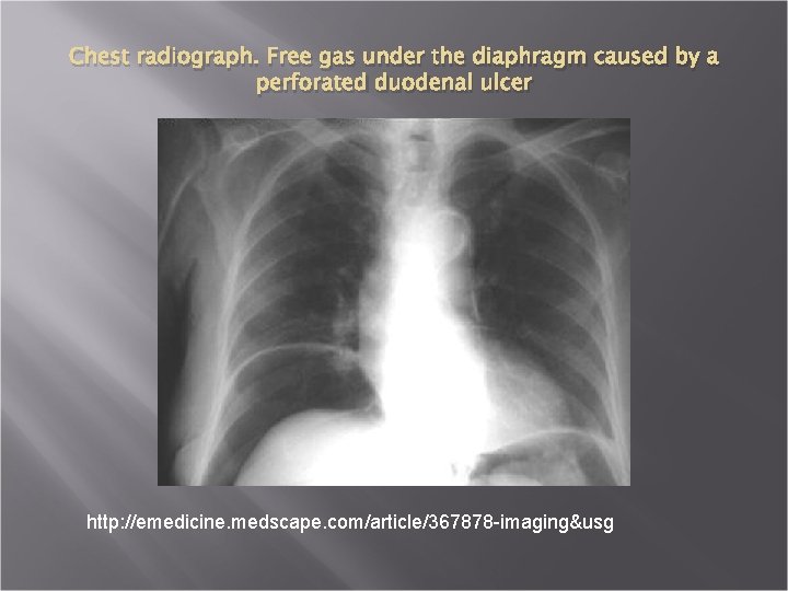 Chest radiograph. Free gas under the diaphragm caused by a perforated duodenal ulcer http: