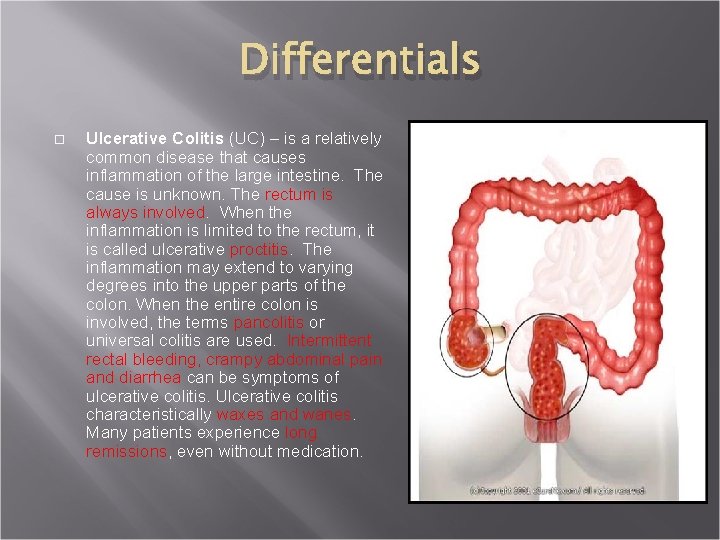 Differentials Ulcerative Colitis (UC) – is a relatively common disease that causes inflammation of