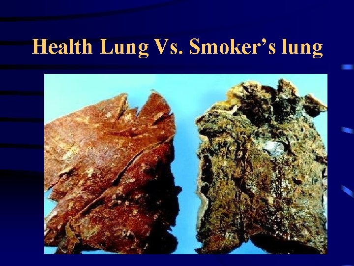 Health Lung Vs. Smoker’s lung 