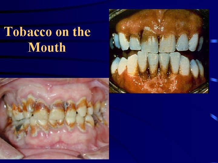 Tobacco on the Mouth 