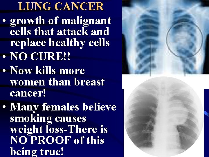  • • LUNG CANCER growth of malignant cells that attack and replace healthy
