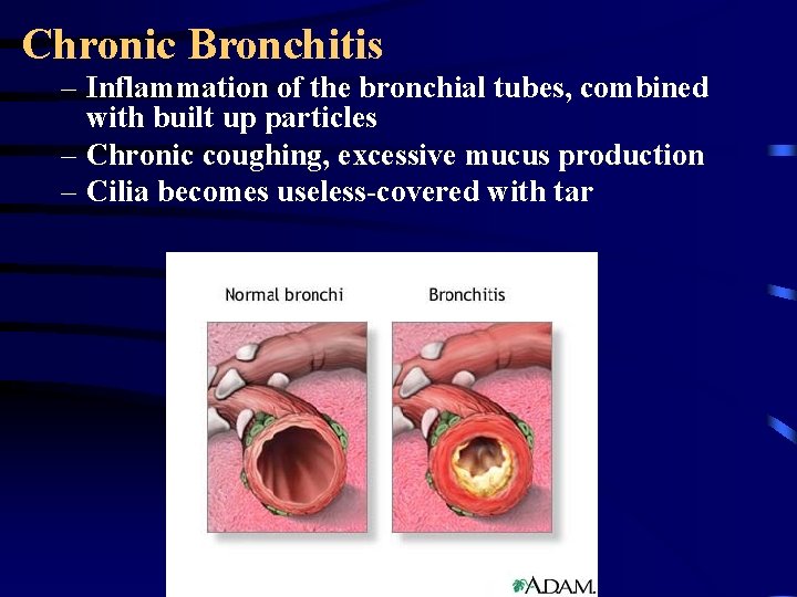 Chronic Bronchitis – Inflammation of the bronchial tubes, combined with built up particles –