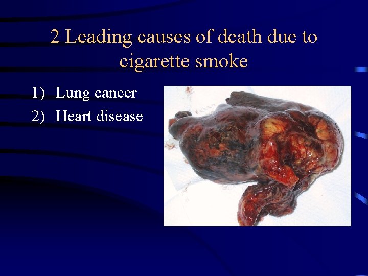 2 Leading causes of death due to cigarette smoke 1) Lung cancer 2) Heart