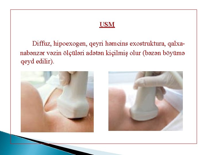 USM Diffuz, hipoexogen, qeyri həmcins exostruktura, qalxanabənzər vəzin ölçüləri adətən kiçilmiş olur (bəzən böyümə