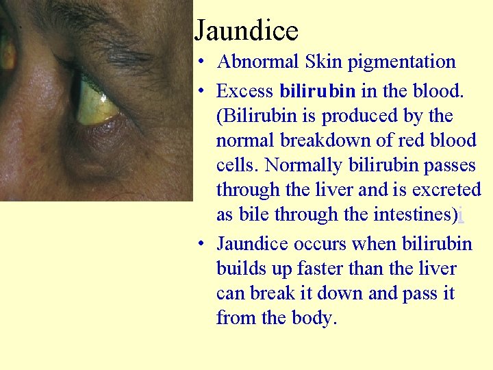 Jaundice • Abnormal Skin pigmentation • Excess bilirubin in the blood. (Bilirubin is produced