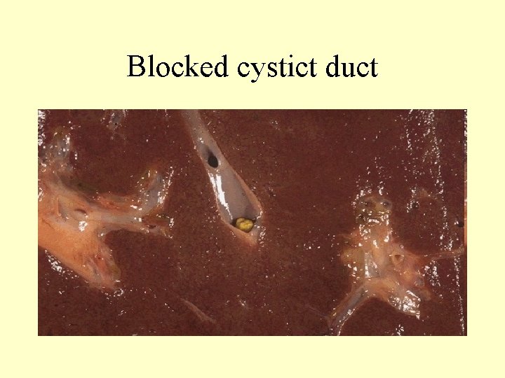 Blocked cystict duct 