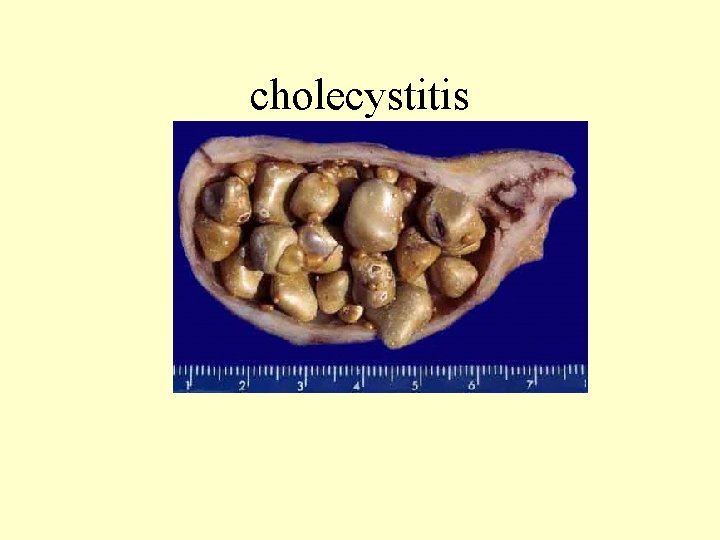 cholecystitis 