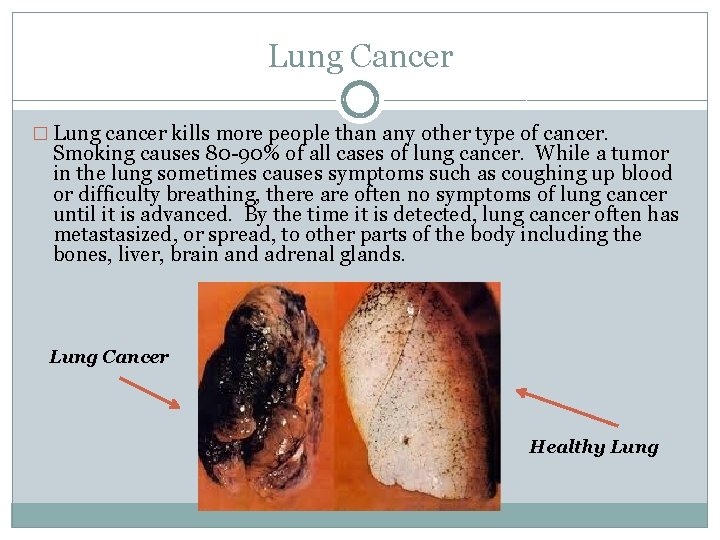 Lung Cancer � Lung cancer kills more people than any other type of cancer.