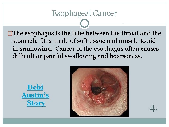 Esophageal Cancer �The esophagus is the tube between the throat and the stomach. It