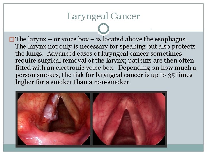 Laryngeal Cancer � The larynx – or voice box – is located above the