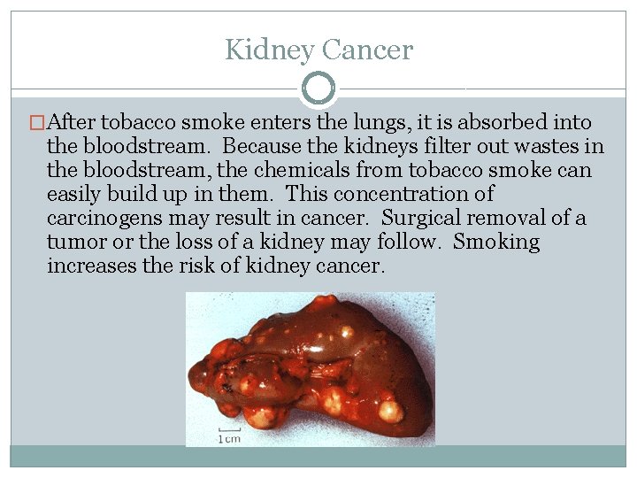 Kidney Cancer �After tobacco smoke enters the lungs, it is absorbed into the bloodstream.