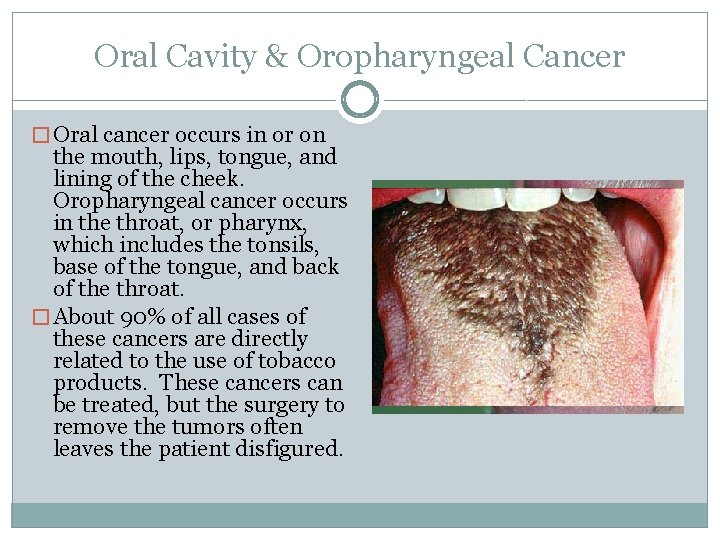 Oral Cavity & Oropharyngeal Cancer � Oral cancer occurs in or on the mouth,