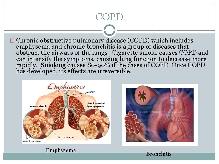 COPD � Chronic obstructive pulmonary disease (COPD) which includes emphysema and chronic bronchitis is