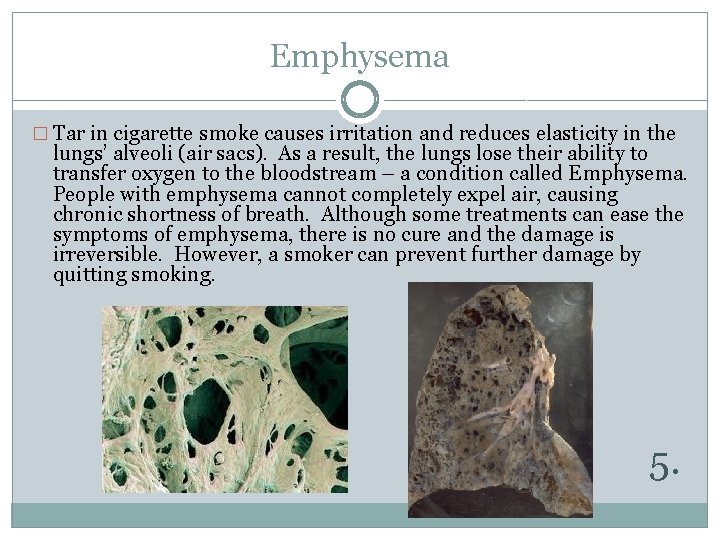 Emphysema � Tar in cigarette smoke causes irritation and reduces elasticity in the lungs’