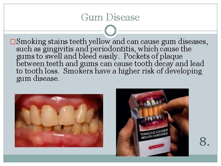 Gum Disease �Smoking stains teeth yellow and can cause gum diseases, such as gingivitis