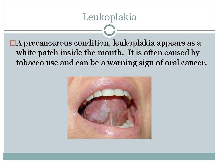 Leukoplakia �A precancerous condition, leukoplakia appears as a white patch inside the mouth. It