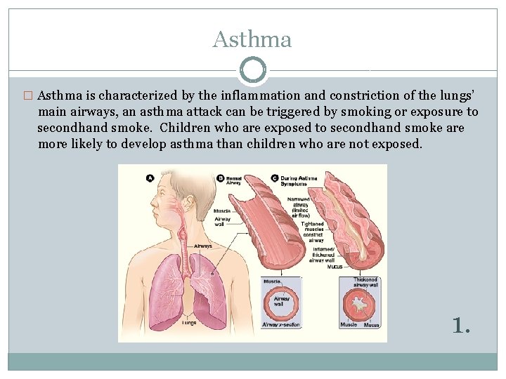 Asthma � Asthma is characterized by the inflammation and constriction of the lungs’ main